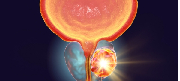 Benign Prostatic Hyperplasia Enlarged Prostate